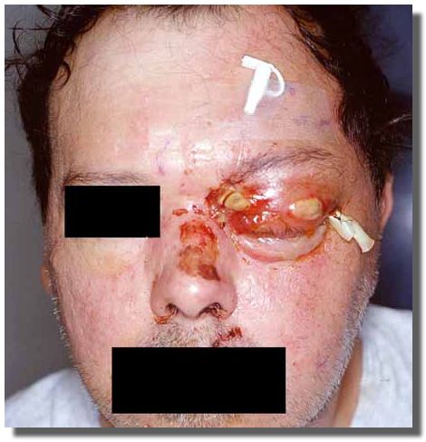 Postoperative image (whole face)