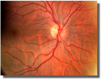 Fundus photograph OD