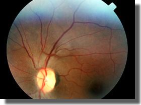 Fundus image OS