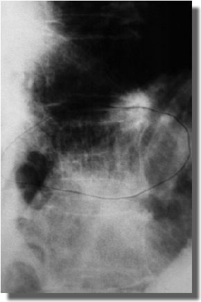 Hemangioma