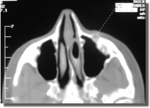 Orbital CT