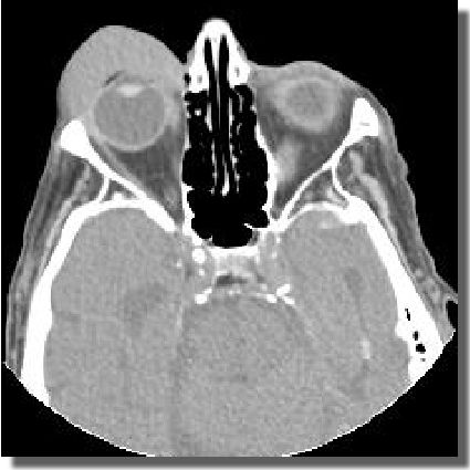 CT scan