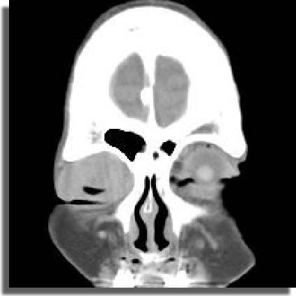 CT Scan