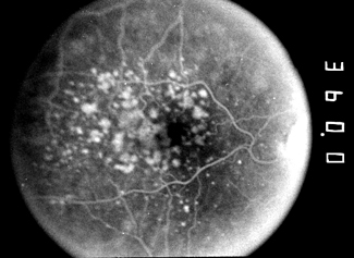 Fluorescein angiogram in age-related macular degeneration