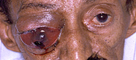 ocular tumors
