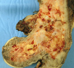 Paget's Sarcoma